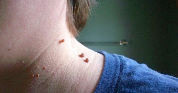 apple_cider_vinegar_skin_tags_solution_1