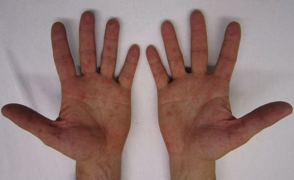 Characteristic_rash_of_hand_foot_and_mouth_disease_on_human_hands-600x3671