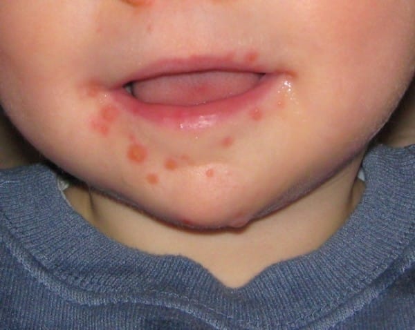 Hand_Foot_Mouth_Disease-600x4781